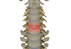 Cervical Degenerative Disc Disease