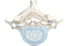 Cervical Degenerative Disorder