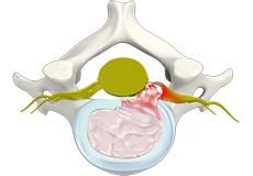 Cervical Disc Herniation