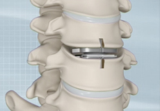 Cervical Disc Replacement