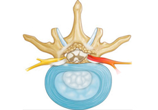 Cervical Radiculopathy/Myelopathy