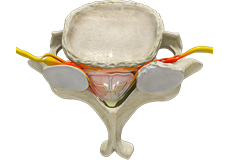 Cervical Stenosis