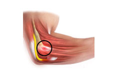 Common Extensor Tendon Origin Repair