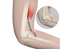 Distal Biceps Repair
