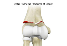 Distal Humerus Fractures Of The Elbow