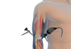 Elbow Arthroscopy