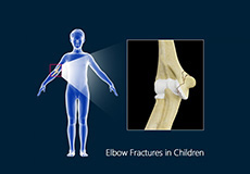 Elbow Fractures In Children