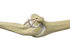Elbow Ligament Reconstruction