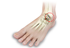 Foot and Ankle Arthritis