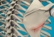 Fracture Of The Shoulder Blade (Scapula)