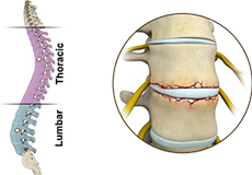 Fracture of the Thoracic and Lumbar Spine