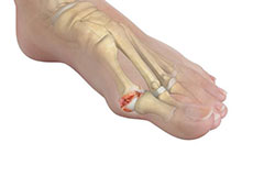 Hallux Rigidus (Big Toe Arthritis)