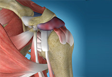 Internal Impingement Of The Shoulder