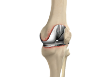 Knee Revision