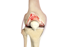 Rheumatoid Arthritis