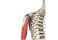 Long Head Biceps Tendon Rupture