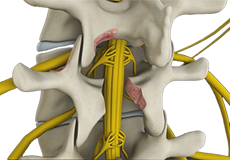 Lumbar Decompression