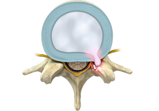 Lumbar Disc Herniation