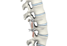 Lumbar Interbody Fusion