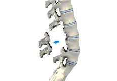 Lumbar Laminectomy