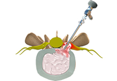 Lumbar Microdiscectomy