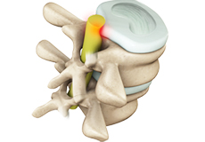 Lumbar Radiculopathy