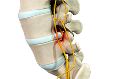 Lumbar Stenosis