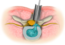 Microscopic Spine Surgery