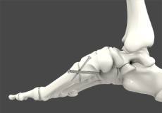 Midfoot Tarsometatarsal Joint Fusion