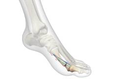 Minimally Invasive Bunion Surgery