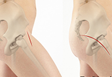 Minimally Invasive Hip Replacement