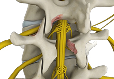 Minimally Invasive Lumbar Decompression