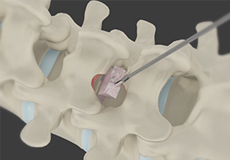 Minimally Invasive Lumbar Discectomy