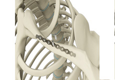 ORIF of the Clavicle Fractures