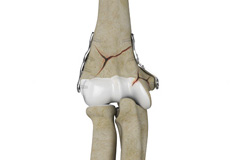 Orif Of The Distal Humerus Fractures