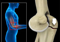 Orif Of The Olecranon Fractures