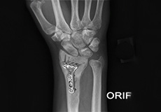 ORIF of Distal Radius Fracture