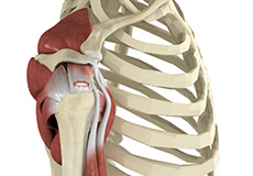 Partial Rotator Cuff Tear