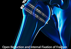 Periprosthetic Shoulder Fracture Fixation