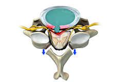 Posterior Cervical Laminectomy and Fusion