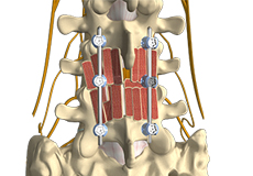 Posterolateral Lumbar Fusion