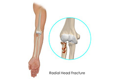 Radial Head Fractures Of The Elbow