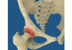 Rheumatoid Arthritis