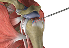 Rotator Cuff Calcification