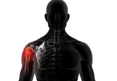 Shoulder Fracture Care