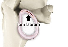 Shoulder Labral Tear with Instability