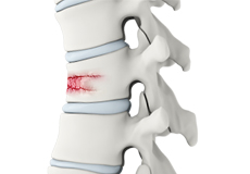 Spinal Compression Fractures