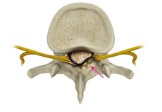 Spinal Stenosis