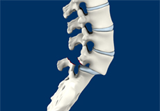 Spondylolisthesis