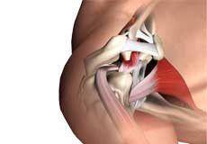 Subacromial Decompression